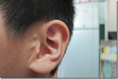 6-1-2e6經由健檢發現異常個案-附耳屏